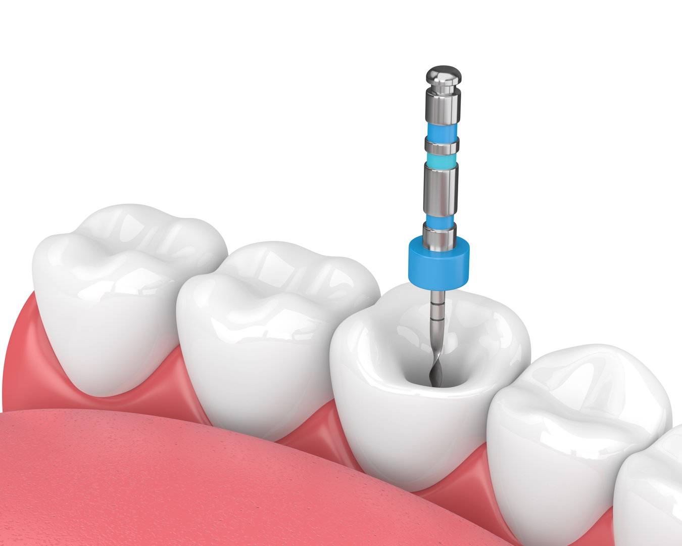 endodontist1